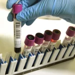 V obci vypukla infekčná choroba, hygienici nariadili očkovanie